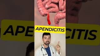 Que es la APENDICITIS⁉️ [upl. by Fannie]