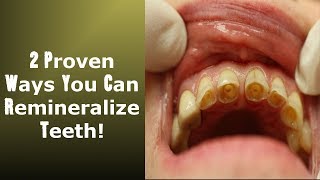 2 Little Known Ways To Achieve Tooth Remineralization Easy To Implement [upl. by Sauer100]