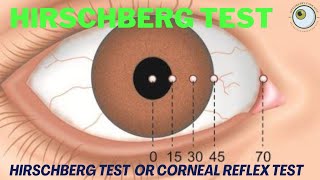 Neurologic Exam Cranial Nerves Normal  Cranial Nerves 2 amp 3 Pupillary Light Reflex [upl. by Nellahs255]