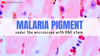 Malaria pigment under the microscope with Haematoxylin and Eosin HampE stain [upl. by Sami506]