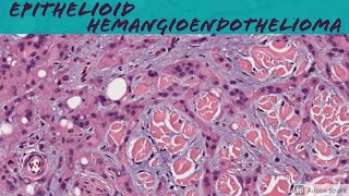 Epithelioid Hemangioendothelioma 101 for Pathologists and Dermatologists [upl. by Elletnahs]