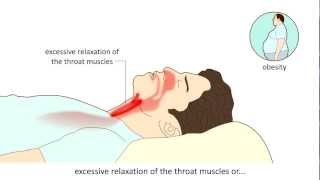 Obstructive Sleep Apnea Syndrome OSAS  Causes and treatment [upl. by Bamby]