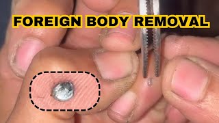 Foreign body removal from hand [upl. by Inohtna238]