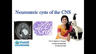 Neurenteric cysts of the CNS [upl. by Annaear]