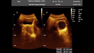 Hemorrhagic cyst USG Report with Thickened Endometrium [upl. by Ytisahc330]