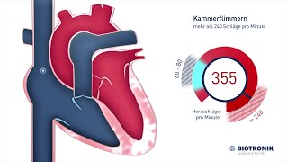 Kammerflimmern amp plötzlicher Herztod Animation [upl. by Sidnac625]