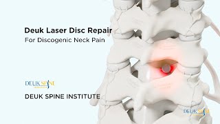 Cervical Deuk Laser Disc Repair DLDR for Discogenic Neck Pain  3D Animation [upl. by Trent]