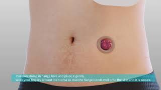 Confort Colostomy Ileostomy Bag Application Video [upl. by Yecam637]