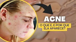 Acne quais os tipos e como é formada [upl. by Assanav193]