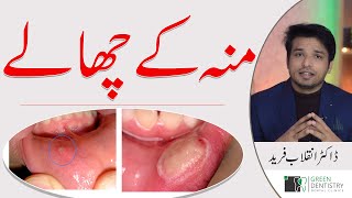 Mouth Ulcers  Oral Ulcers  Causes  Home Treatment  Prevention  Dr Inqalab F  Urdu  Hindi [upl. by Essilevi]