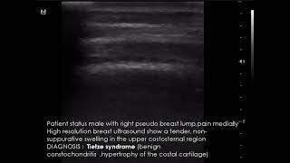 CASE 956 Tietze syndrome [upl. by Encratis527]