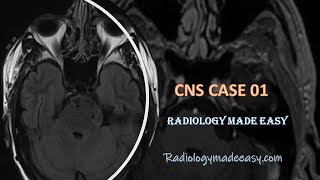 A patient presented with headache and vertigo  FRCR Neurology cases01 [upl. by Aelanej]