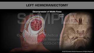 Left Hemicraniectomy  Medical Animation [upl. by Aural276]