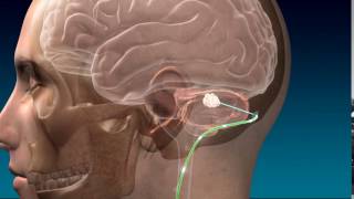 Deep Brain Stimulation for Stroke Recovery Animation [upl. by Elna277]