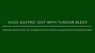 Sleeve gastrectomy with distal pancreaticosplenectomy for Huge gastric GIST [upl. by Champagne]