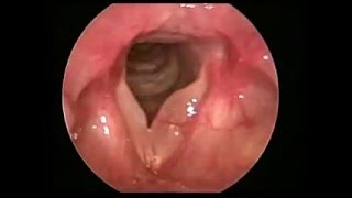 聲帶水腫息肉 Reinkes edema with vocal polyp [upl. by Adnawyek]