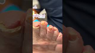 RAWR toenails nails feet footdoctor healthyfeetpodiatry [upl. by Irb]