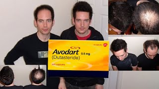 Dutasteride is just BETTER for Hair Loss [upl. by Ilarin45]