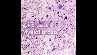 Myelofibrosis Considering TP53 and PostMPN AML [upl. by Ynavoj]