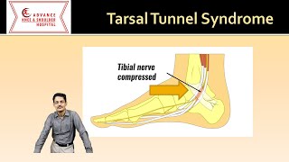 Tarsal tunnel syndrome Everything you need to know [upl. by Atin]