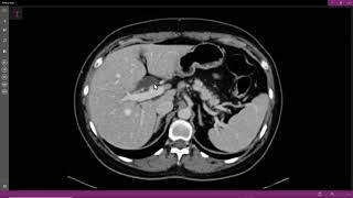 Carcinoma de pâncreas [upl. by Sairtemed]