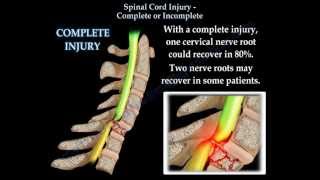 Spinal Cord Injury Complete Or Incomplete  Everything You Need To Know  Dr Nabil Ebraheim [upl. by Cotter]