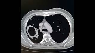 Pulmonary tuberculosis Tuberculous tracheobrnchitis [upl. by Viv264]