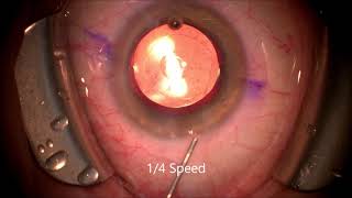 Vivity San Antonio Intraocular LensIOL JT Kavanagh MD San Antonio Best Cataract Surgery 2021 [upl. by Doralyn723]