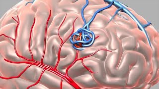 Arteriovenous Malformation AVM [upl. by Atiek617]