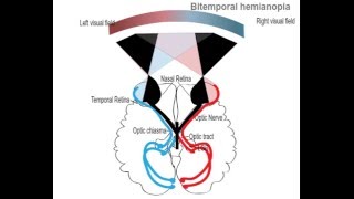 Bitemporal hemianopia [upl. by Haras]