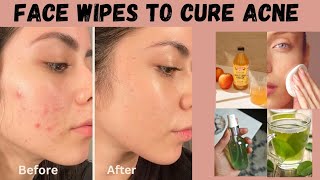 how to get rid of acne DIY face wipe pimples removal toner [upl. by Bedelia]