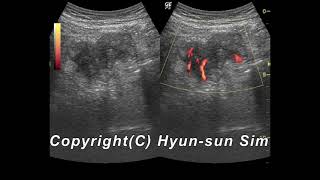 Cecal cancer ultrasonography맹장암 [upl. by Eidda]