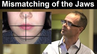 Effect of Midline Discrepancy Mismatching or Facial Asymmetry on Facial Appearance by Dr Mike Mew [upl. by Nelak]