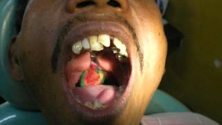 Dr Pankaj Kharade Pharyngeal obturator impression [upl. by Laehcim]