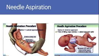 How to drain pneumothorax needle aspiration procedure lateral approach anterior approach [upl. by Lleuqar]