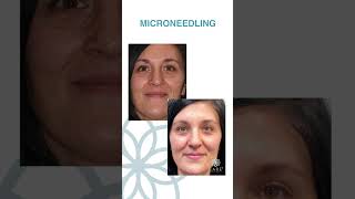 Microneedling with PRF  CARE Esthetics Before and After [upl. by Ardnos]