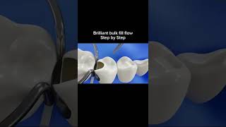 Laser filling  composite filling  tooth repair dentalcaries dentist dentalfilling [upl. by Walston411]