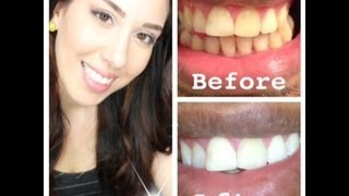 My At Home Teeth Whitening Routine WITH BEFORE AND AFTER PICTURES [upl. by Ahsemal]