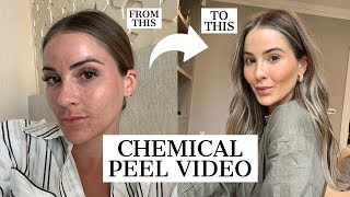 CHEMICAL PEEL  HOW I HEALED MY PIGMENTATION  NADIA ANYA [upl. by Horton135]