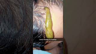 Leech therapy for hairalopeciadoctoraiiaalternativemedicineayurvedaayushpanchkarmatreatment [upl. by Assilat125]