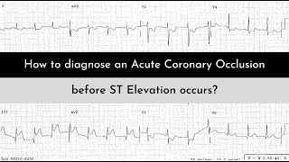 STEMINSTEMI vs OMINOMI A Paradigm Shift in ECG interpretation of MI [upl. by Latimer]