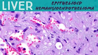 Rare Liver Tumor  Epithelioid hemangioendothelioma Basic soft tissue pathology [upl. by Yenial]