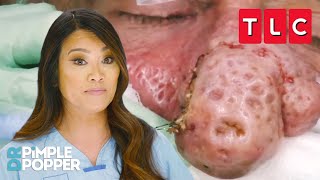 Bumpiest Nose Growths  Dr Pimple Popper  TLC [upl. by Doloritas]