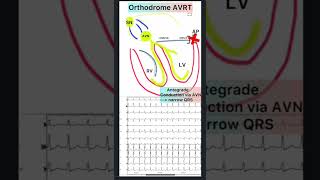 WPW phenomenon and WPW syndrome [upl. by Ahiel]