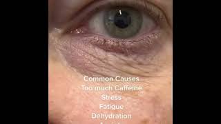 Blepharospasm shortvideoopthalmiceyesoptometristfactsstresscaffiene [upl. by Ttoille150]