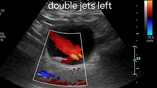 Double ureteral jets unilaterally  bladder calculus ultrasound and color Doppler imaging [upl. by Helbonna]