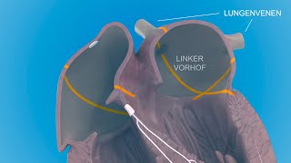 Herzrhythmusstörungen  das Vorhofflimmern [upl. by Aihsemek]