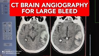 BRAIN HEMORRHAGE  CT SCAN ANGIOGRAPHY [upl. by Reckford]