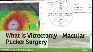 Vitrectomy  Macular Pucker Surgery and Recovery [upl. by Oirromed]