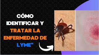 Cómo Identificar y Tratar la Enfermedad de Lymequot [upl. by Fish]